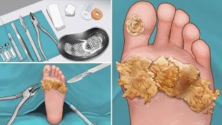 How to Remove Plantar Warts - Asmr Surgery (with a Foot Callus Removal animation