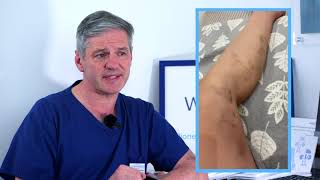 Prof Mark Whiteley explains recovery from varicose vein treatment