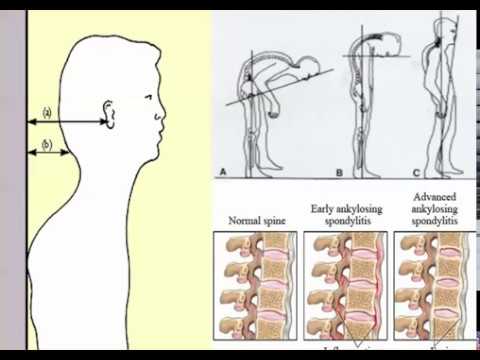 Spine Conference Ankylosing Spondylitis Youtube