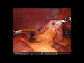 small bowel resection with ica for primary small bowel adenocarcinoma