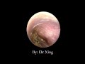 dr xing earwax cleaning 2019 10 9