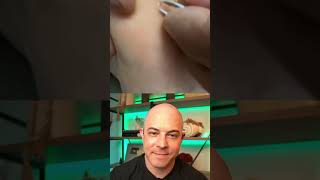 Derm reacts to INSANE splinter in foot! #dermreacts #doctorreacts #splinterremoval