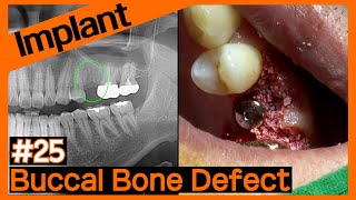 [Online Surgery] Implant placement \u0026 Intrasocket graft using A-Oss