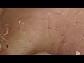 shocking cystic blackheads u0026 whiteheads extraction revealed new blackheads this week 11 609