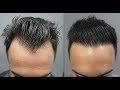 1901 Grafts. Hair Transplant by FUE Technique. Injertocapilar.com.1730/2016