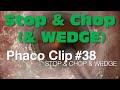 Phaco Clip #38 - Stop & Chop & WEDGE