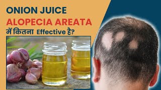 Does Onion Juice Help with Alopecia Areata? | Alopecia Areata Treatment in Delhi