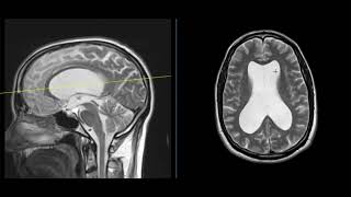 Vertigo in 61 year old lawyer