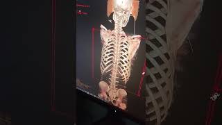 3 D CT scan