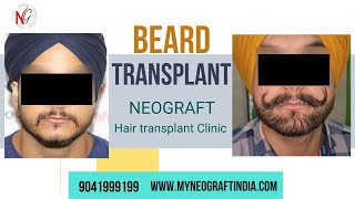 Beard Transplant | ਦਾੜੀ ਅਤੇ ਮੁੱਛ ਨੂੰ ਹੈਵੀ ਕਿਵੇਂ ਕਰੀਏ | Medicine for beard growth at home