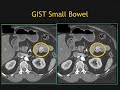 CT of Small Bowel GIST Tumors: Imaging and Theory Part 2