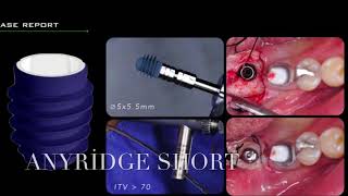 CAGDENTAL MEGAGEN ANYRİDGE SHORT