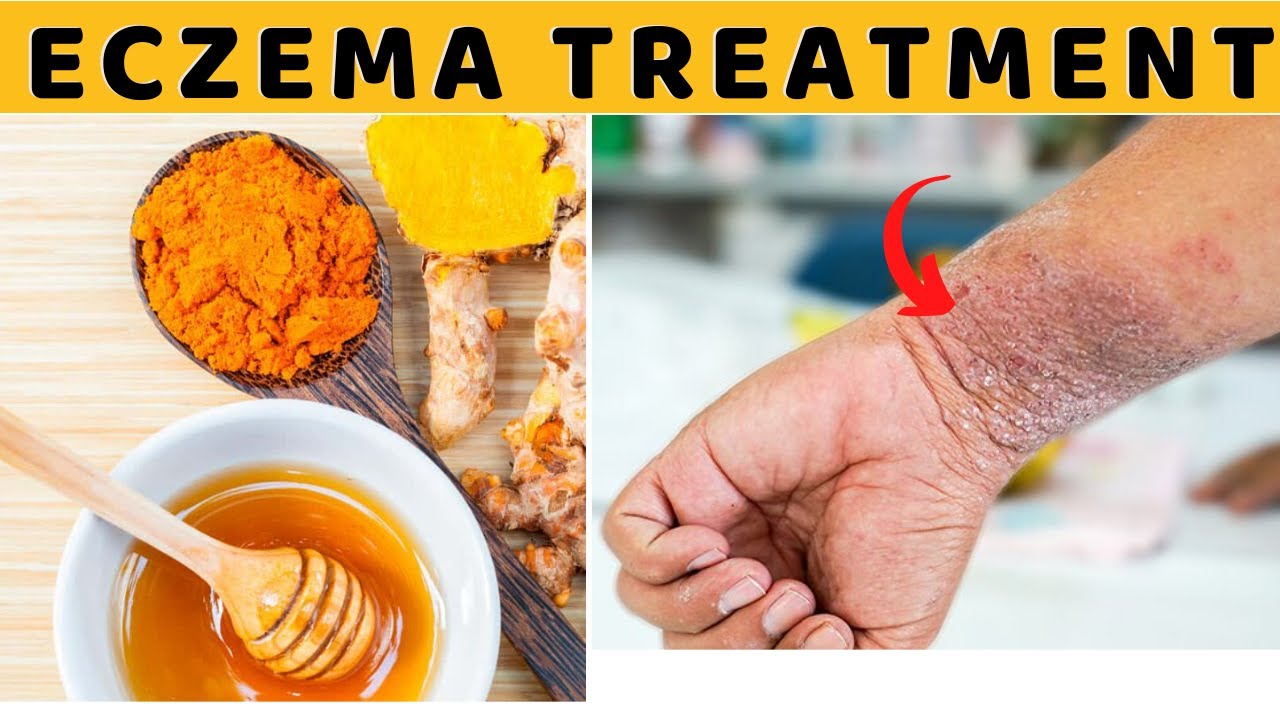 How To Cure Eczema Permanently Fast Naturally At Home - Over The ...