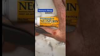 Neosporin Allergy #shorts