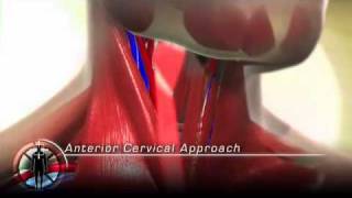 Anterior Cervical Approach