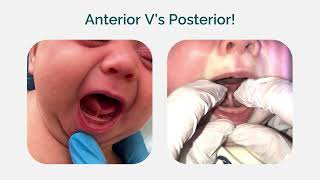 True posterior tongue-tie | Osteopathic and Chiropractic CPD