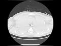 chest ct bilateral total lung atelectasis