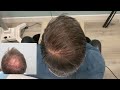 crown hair restoration with 2500 grafts fue