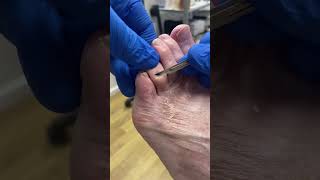 Dig into this toe-curling journey of corn \u0026 callus removal by Aussie podiatrist!