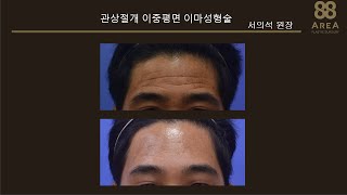 남자이마주름성형은 어떤 수술을 받아야될까