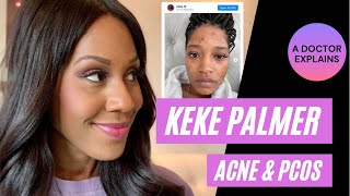 Keke Palmer Reveals Acne & Polycystic Ovarian Syndrome (PCOS). A Doctor Discusses