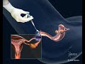 intrauterine insemination iui