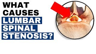 What Are The Main Causes Of Spinal Stenosis? (LUMBAR SPINAL STENOSIS) | Dr. John Zielonka