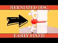 Herniated Disc Clearly Explained & Easily Fixed