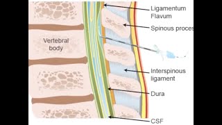 Thoracic epidural anesthesia