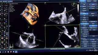 4D demonstration of pulmonary artery