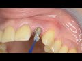 Cementation of a Lava™ all zirconia crown using RelyX™ Ultimate Clicker™ Adhesive Resin Cement