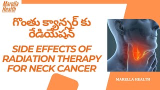 గొంతు క్యాన్సర్ కు రేడియేషన్ | Side Effects of Radiation Therapy for Neck Cancer | Marella health