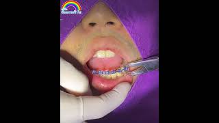 Braces removal l การถอดเหล็กจัดฟัน หลังจากจัดฟันเสร็จแล้ว