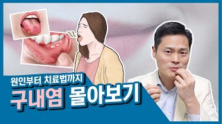 구내염 전체 몰아보기, 구내염 원인, 증상과 치료 및 관리의 모든 것