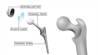 What is a total hip replacement? | Ohio State Medical Center