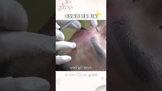 미간주름없애기! 미간필러 위험하진 않을까? #shorts #미간필러