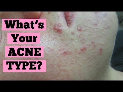 Acne Type: Inflamed Acne or Non Inflamed Acne? | Cysts Blackheads Closed Comedones Acne Type: Inflamed Acne or Non Inflamed Acne? | Cysts Blackheads Closed Comedones