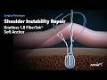 Knotless 1.8 FiberTak® Soft Anchor for Shoulder Instability Repair