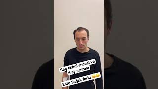 Saç ekimi operasyonu öncesi ve sonrası karşılaştırması  📲 +90 532 475 37 83  📲 +90 542 541 37 83