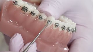 Damon self ligating orthodontic appliance: Bracket opening and closing quick demonstration