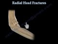 Radial Head Fracture- Everything You Need To Know- Dr. Nabil Ebraheim