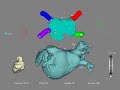 pulmonary vein radiofrequency catheter ablation therapy for atrial fibrillation