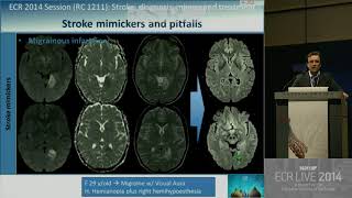 Neuro RC 1211   Stroke diagnosis, mimics and treatment 2