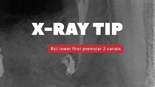 X-Ray Tip in root canal treatment lower premolar 2 canals