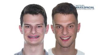Jaw surgery Case # 105: Gustavo - Short face, overbite, maxilo-mandibular retrus