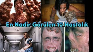 DUYDUĞUNUZDA ŞOK OLACAĞINIZ 10 İLGİNÇ HASTALIK 😱 ! - Dünyanın En nadir görülen 10 Hastalığı 😱😮