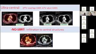 Session-6 “overview of SBRT in lung cancer.” by Dr Shyam Part A