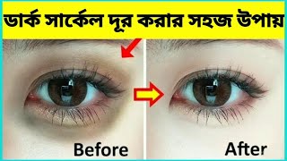 মাত্র 5 মিনিটে চোখের নিচের সমস্ত কালো দাগ গায়েব।How To Remove Dark Circles Overnight