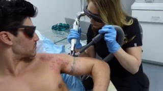 Model Miguel Iglesias 7th Tattoo Removal Treatment