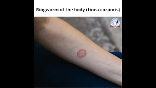 Ringworm of the body (tinea corporis) || Know Symptoms and Causes Ringworm of the body || SLMSH